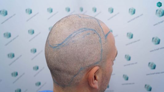 Injerto Capilar Técnica FUE Grafts 3362 (8806 Pelos) 12 15 DISENO LINEA INJERTO CAPILAR