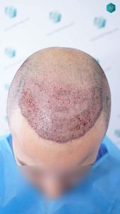 Injerto Capilar Técnica FUE Grafts 4.516 (11.888 Pelos) 15 16 DISENO LINEA DE INJERTO