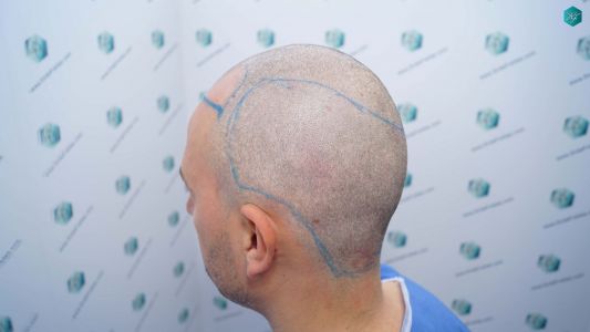 Injerto Capilar Técnica FUE Grafts 3362 (8806 Pelos) 13 16 DISENO LINEA INJERTO CAPILAR