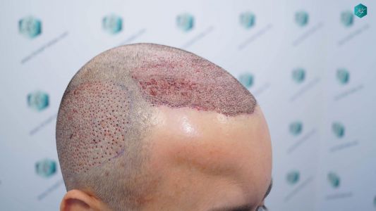 Injerto Capilar Técnica FUE Grafts 4.516 (11.888 Pelos) 16 17 DISENO LINEA DE INJERTO