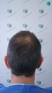 Injerto Capilar Técnica FUE Grafts 4924 (11170 Pelos) 11 17 DISENO LINEA INJERTO