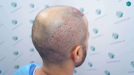 Injerto Capilar Técnica FUE Grafts 4.516 (11.888 Pelos) 17 17A DISENO LINEA DE INJERTO