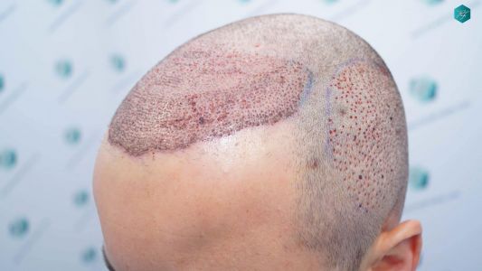 Injerto Capilar Técnica FUE Grafts 4.516 (11.888 Pelos) 18 18 DISENO LINEA DE INJERTO