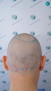 Injerto Capilar Técnica FUE Grafts 3362 (8806 Pelos) 14 18 DISENO LINEA INJERTO CAPILAR