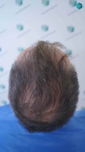 Injerto Capilar Técnica FUE Grafts 4924 (11170 Pelos) 12 18 DISENO LINEA INJERTO