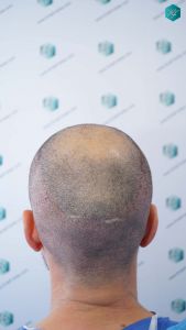 Injerto Capilar Técnica FUE Grafts 4.516 (11.888 Pelos) 20 19 DISENO LINEA DE INJERTO