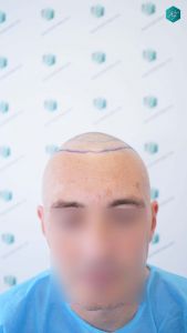 Injerto Capilar Técnica FUE Grafts 4924 (11170 Pelos) 13 19 DISENO LINEA INJERTO