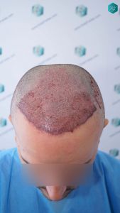 Injerto Capilar Técnica FUE Grafts 3362 (8806 Pelos) 16 20 TRASPLANTE CAPILAR