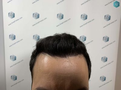 Injerto Capilar Técnica FUE Grafts 4.516 (11.888 Pelos) 21 21 RESULTADOS A LOS 12 MESES