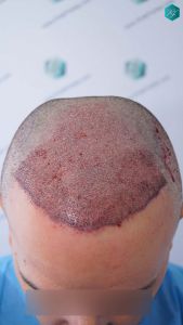 Injerto Capilar Técnica FUE Grafts 3362 (8806 Pelos) 17 21 TRASPLANTE CAPILAR