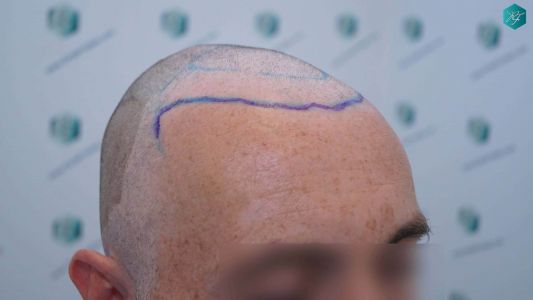Injerto Capilar Técnica FUE Grafts 4924 (11170 Pelos) 15 22 DISENO LINEA INJERTO