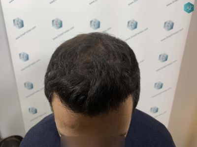 Injerto Capilar Técnica FUE Grafts 4.516 (11.888 Pelos) 22 22 RESULTADOS A LOS 12 MESES