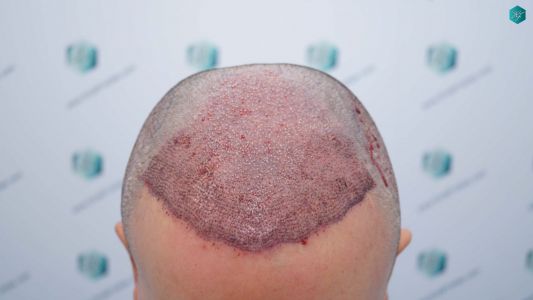 Injerto Capilar Técnica FUE Grafts 3362 (8806 Pelos) 18 22 TRASPLANTE CAPILAR