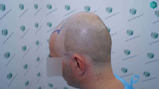 Injerto Capilar Técnica FUE Grafts 4924 (11170 Pelos) 17 22B DISENO LINEA INJERTO scaled 1