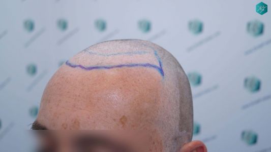 Injerto Capilar Técnica FUE Grafts 4924 (11170 Pelos) 18 23 DISENO LINEA INJERTO
