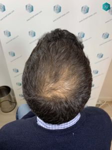 Injerto Capilar Técnica FUE Grafts 4.516 (11.888 Pelos) 23 23 RESULTADOS A LOS 12 MESES