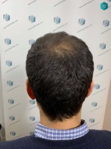Injerto Capilar Técnica FUE Grafts 4.516 (11.888 Pelos) 24 24 RESULTADOS A LOS 12 MESES