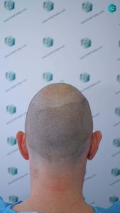 Injerto Capilar Técnica FUE Grafts 4924 (11170 Pelos) 20 25 DISENO LINEA INJERTO