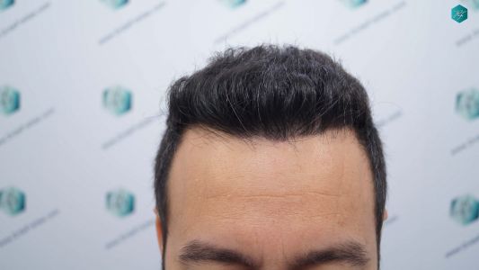 ANTES DEL TRASPLANTE 26 ANTES DEL TRASPLANTE