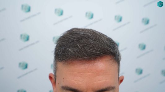Injerto Capilar Técnica FUE Grafts 3362 (8806 Pelos) 22 26A RESULTADOS A LOS 12 MESES