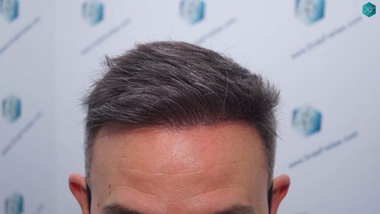 Injerto Capilar Técnica FUE Grafts 3362 (8806 Pelos) 23 26AB RESULTADOS A LOS 12 MESES