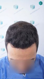 Injerto Capilar Técnica FUE Grafts 4.516 (11.888 Pelos) 25 27 RESULTADOS A LOS 12 MESES