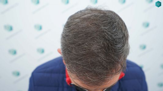 Injerto Capilar Técnica FUE Grafts 3362 (8806 Pelos) 24 28 RESULTADOS A LOS 12 MESES 1