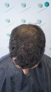 Injerto Capilar Técnica FUE Grafts 4.516 (11.888 Pelos) 26 28 RESULTADOS A LOS 12 MESES