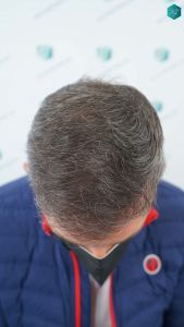 Injerto Capilar Técnica FUE Grafts 3362 (8806 Pelos) 25 29 RESULTADOS A LOS 12 MESES 1