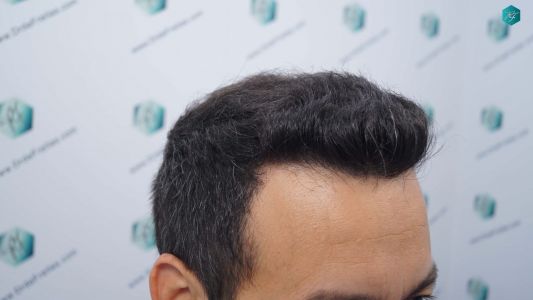 Injerto Capilar Técnica FUE Grafts 4.516 (11.888 Pelos) 27 29 RESULTADOS A LOS 12 MESES