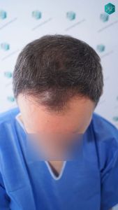 Injerto Capilar Técnica FUE Grafts 3362 (8806 Pelos) 1 3 ANTES DEL TRASPLANTE CAPILAR 2