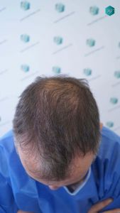 Injerto Capilar Técnica FUE Grafts 4924 (11170 Pelos) 40 3 ANTES DEL TRASPLANTE CAPILAR