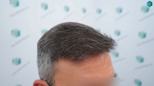 Injerto Capilar Técnica FUE Grafts 3362 (8806 Pelos) 26 30 RESULTADOS A LOS 12 MESES 1
