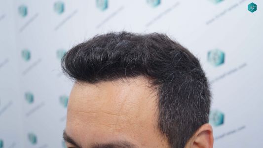 Injerto Capilar Técnica FUE Grafts 4.516 (11.888 Pelos) 28 30 RESULTADOS A LOS 12 MESES
