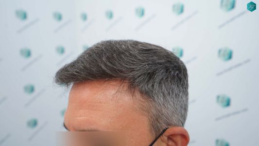 Injerto Capilar Técnica FUE Grafts 3362 (8806 Pelos) 27 31 RESULTADOS A LOS 12 MESES 1
