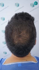 Injerto Capilar Técnica FUE Grafts 4.516 (11.888 Pelos) 29 31 RESULTADOS A LOS 12 MESES