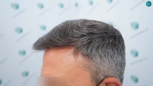 Injerto Capilar Técnica FUE Grafts 3362 (8806 Pelos) 28 32 RESULTADOS A LOS 12 MESES 1