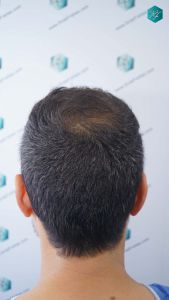 Injerto Capilar Técnica FUE Grafts 4.516 (11.888 Pelos) 30 32 RESULTADOS A LOS 12 MESES