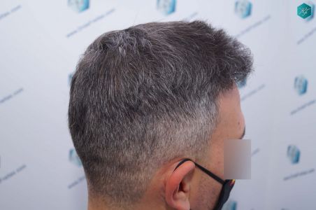 Injerto Capilar Técnica FUE Grafts 3362 (8806 Pelos) 29 32A RESULTADOS A LOS 12 MESES 1