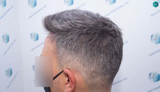 Injerto Capilar Técnica FUE Grafts 3362 (8806 Pelos) 30 32B RESULTADOS A LOS 12 MESES 1