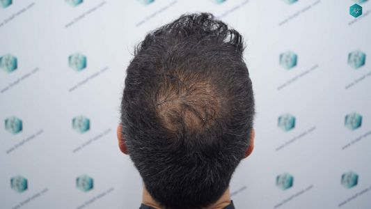 Injerto Capilar Técnica FUE Grafts 4.516 (11.888 Pelos) 31 33 RESULTADOS A LOS 12 MESES 1