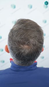 Injerto Capilar Técnica FUE Grafts 3362 (8806 Pelos) 31 33 RESULTADOS A LOS 12 MESES 2