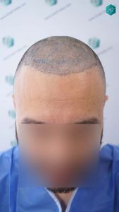 DISENO LINEA INJERTO 34 DISENO LINEA INJERTO