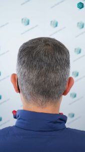 Injerto Capilar Técnica FUE Grafts 3362 (8806 Pelos) 32 34 RESULTADOS A LOS 12 MESES 1