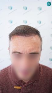 Injerto Capilar Técnica FUE Grafts 4924 (11170 Pelos) 29 34 RESULTADOS A LOS 12 MESES