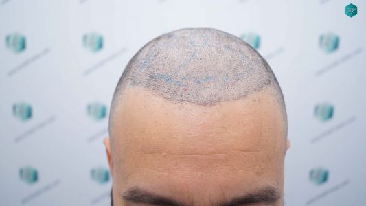 Injerto Capilar Técnica FUE Grafts 4.516 (11.888 Pelos) 32 35 DISENO LINEA INJERTO