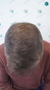 Injerto Capilar Técnica FUE Grafts 4924 (11170 Pelos) 30 35 RESULTADOS A LOS 12 MESES