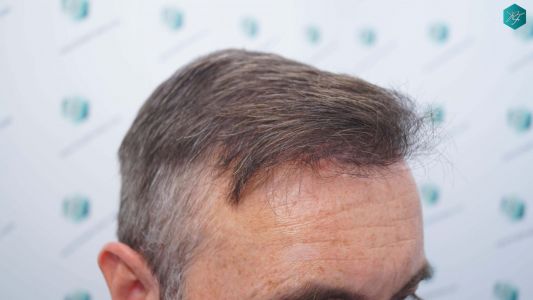 Injerto Capilar Técnica FUE Grafts 4924 (11170 Pelos) 31 35B RESULTADOS A LOS 12 MESES