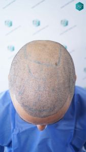 Injerto Capilar Técnica FUE Grafts 4.516 (11.888 Pelos) 33 36 DISENO LINEA INJERTO