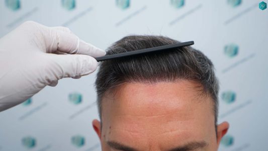 Injerto Capilar Técnica FUE Grafts 3362 (8806 Pelos) 33 36 RESULTADOS A LOS 12 MESES 1